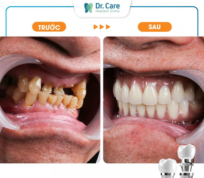 Slider image (6) Dr. Care Implant Clinic